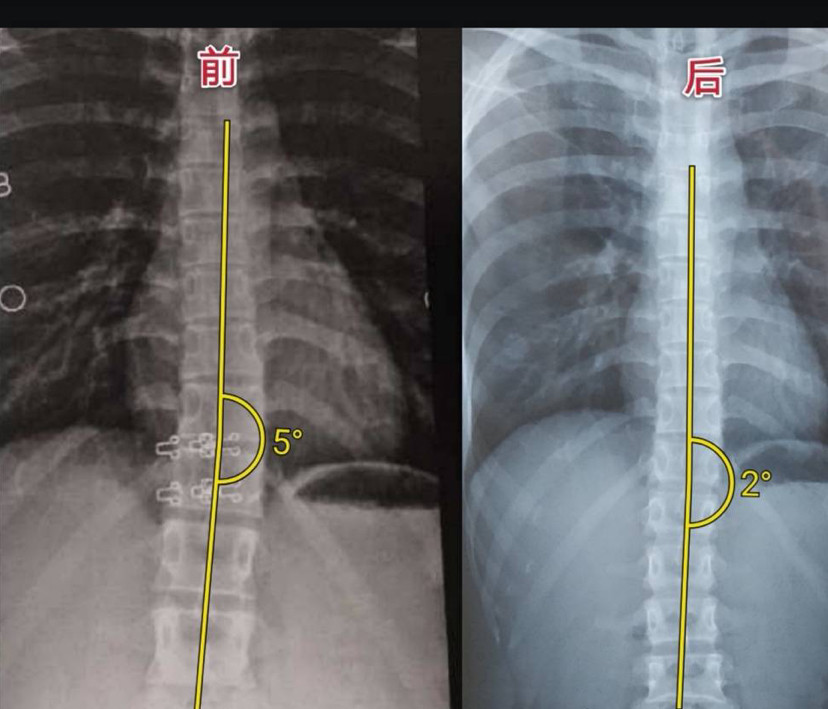 北京小伙子脊柱侧弯5度以内,康复一段时间后凭肉眼根本看不出来的,想