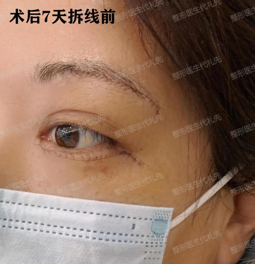 提眉能保持几年_眉毛可以提高位置吗_眉眼提升能保持多久