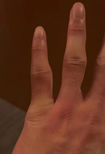 郭艾伦受伤手指曝光无名指红肿带伤出战这一幕让人看着心疼