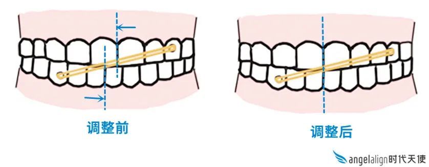 b 调整中线拔牙收缝通过持续给力移动牙齿,来慢慢收缝.