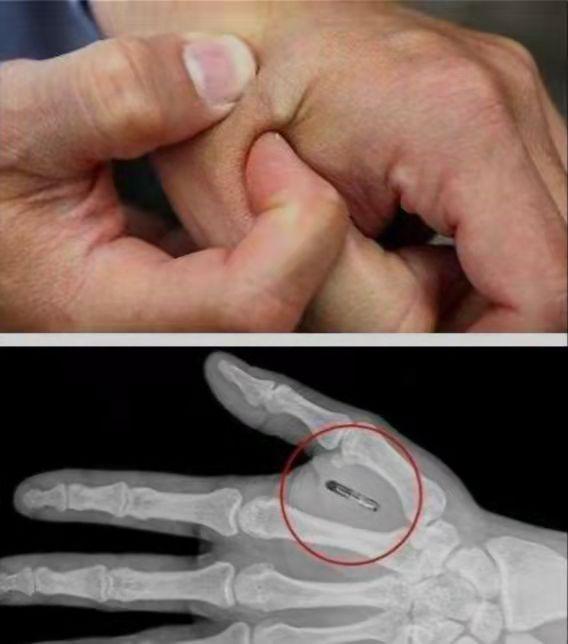 更离谱的是,在一个x光片中,医生竟然发现男子的手上被植入了一种类似
