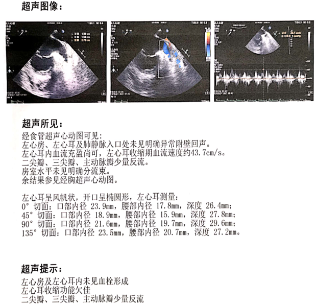 4.经食道超声:左心耳及左心房未见血栓(图5).图4 心脏彩超3.