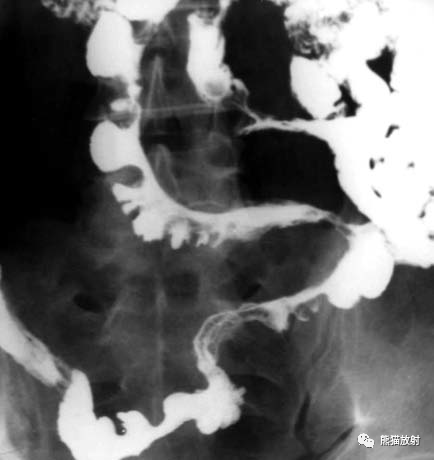 溃疡性结肠炎,克罗恩病的影像图例及鉴别诊断