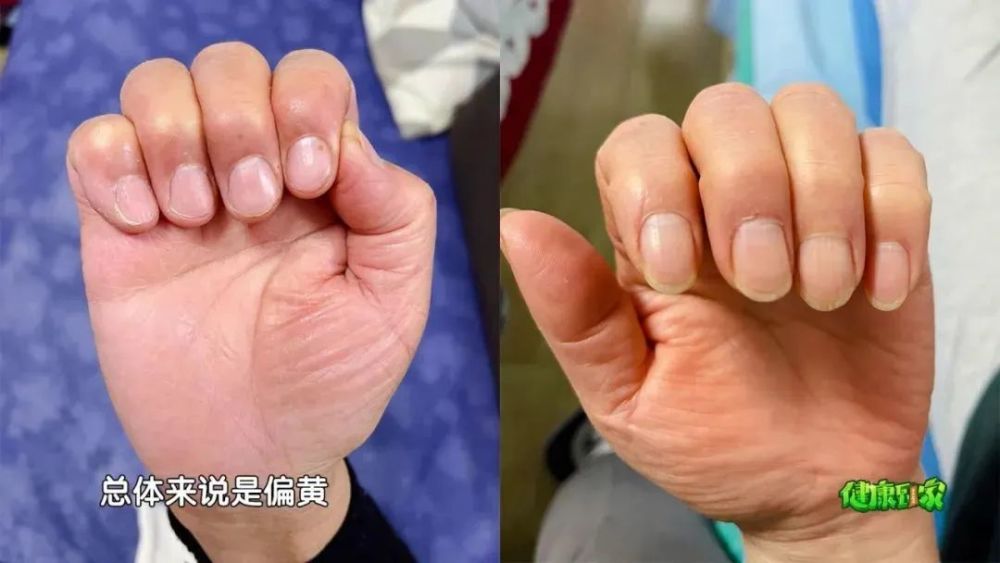图片靠左的手,指甲偏红,还有红斑,属于热证,热会迫血妄行,容易伴有