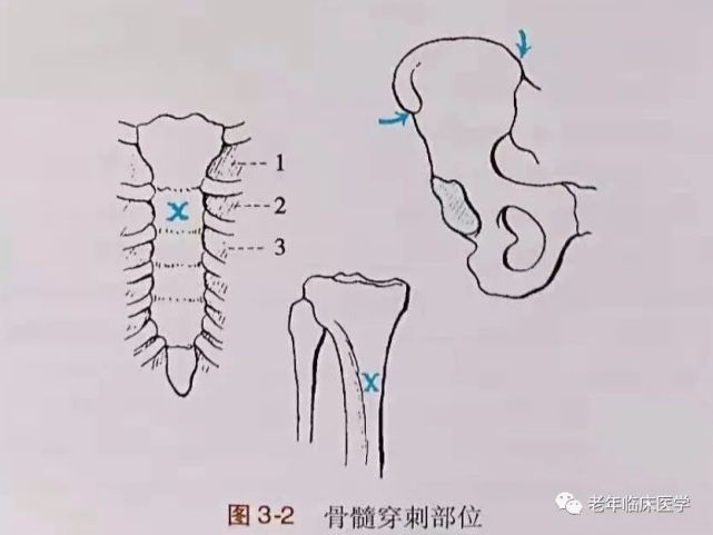 髂嵴穿刺术穿刺类型3.