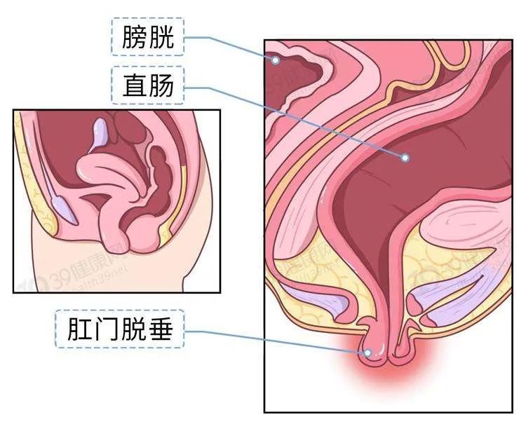 直肠脱垂肛门处长了个小尾巴
