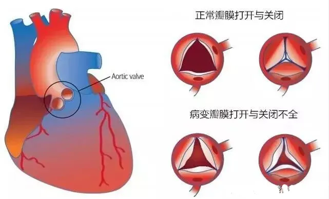 李晋新教授:心脏三尖瓣少量反流需要注意什么