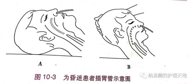 男性,67歲,昏迷狀態,根據患者的病情,需要給患者留置胃管,以便於進行