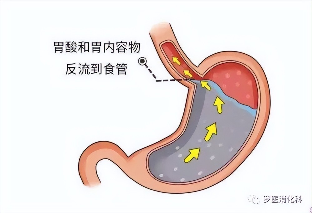 食管,引起不適症狀和(或)併發症,部分患者反流物還能到達咽喉部及口腔