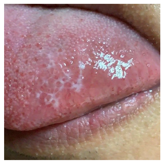 舌头上为啥长网状白斑复旦华山医院团队bmj发表病例