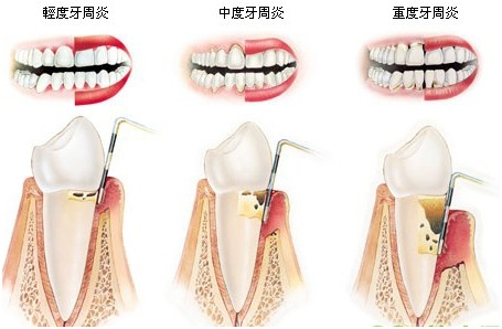 牙周炎能用衝牙器嗎?口腔個護師在線科普