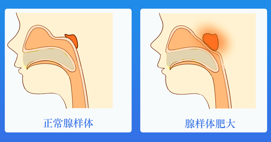 孩子腺樣體肥大要不要手術看看這些案例就懂了