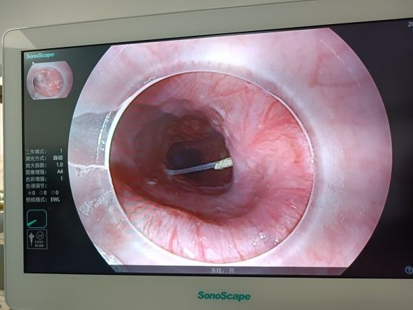 鱼刺卡着了吞口饭就下去了吧结果鱼刺进了食道