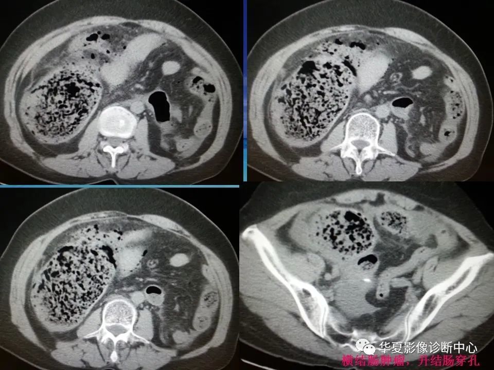 消化道穿孔ct影像大汇总,看完印象深刻!_腾讯新闻