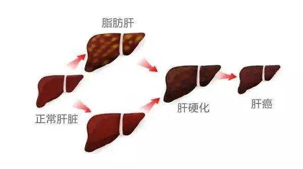 脂肪肝的5大危害,別再不當回事!