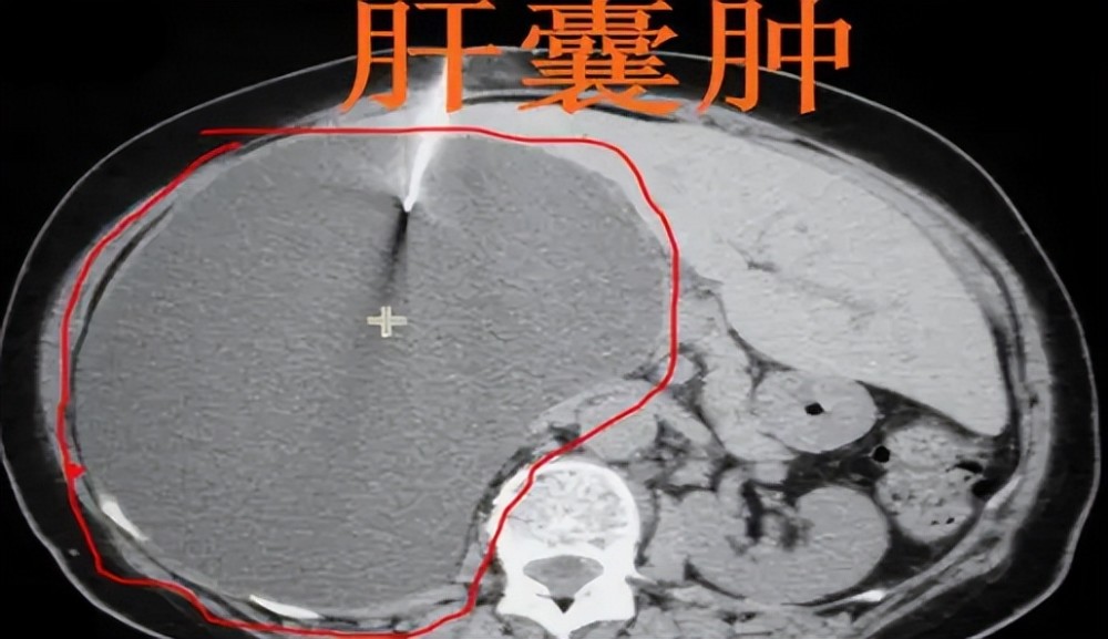 患上肝囊腫怎麼辦體積超過這個範圍該進行手術治療