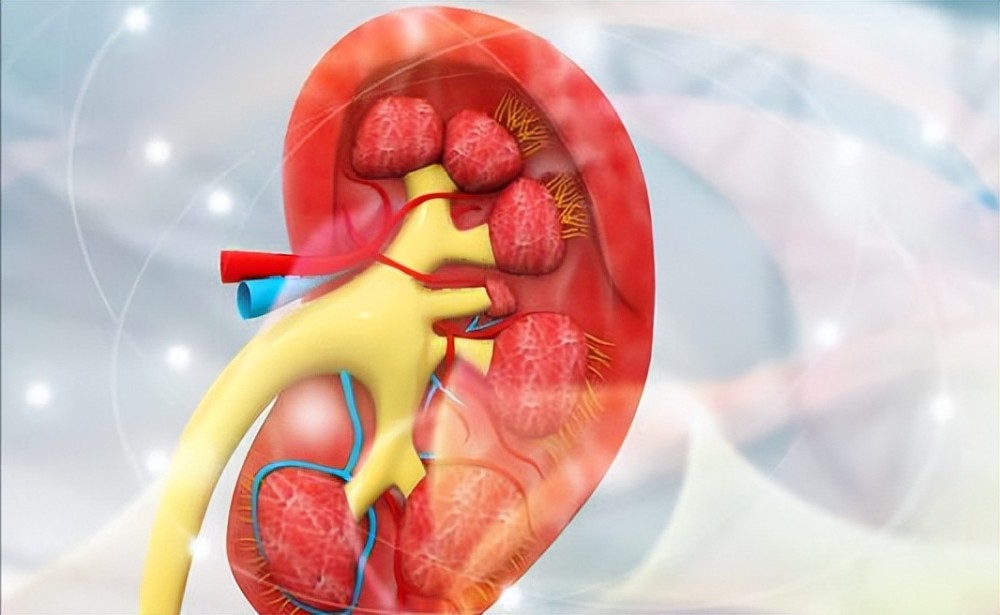 腎功能不全血鉀高是怎麼回事?腎病科醫生總結出4個常見原因_騰訊新聞