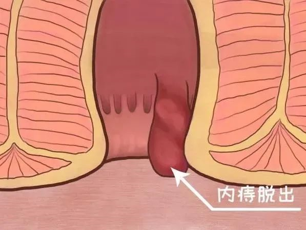 【大连阳光肛肠医院】痔疮脱出要及时回纳,这些方法一定要注意!