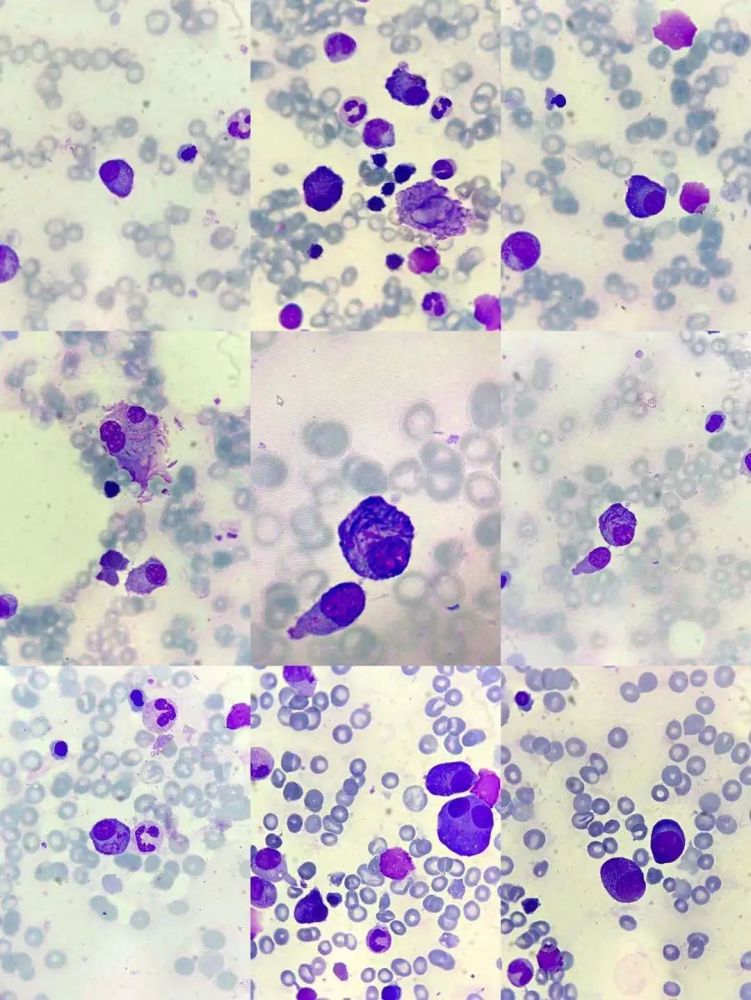 骨髓涂片中出现auer小体样包涵体浆细胞增多会是mm吗?_腾讯新闻