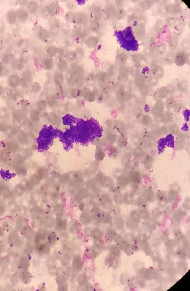 一例儿童马耳他布鲁氏菌血流感染病例分享_腾讯新闻