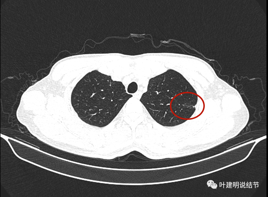 而突然新發了一個大結節: