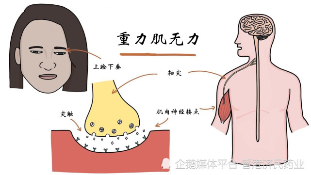 ultomirisravulizumab在美國獲批用於成人全身性重症肌無力