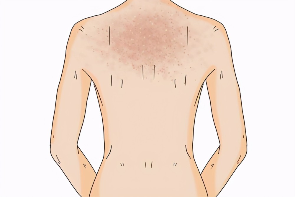 鸡皮肤炎症需要忌口吗(鸡皮肤炎症需要忌口吗图片)