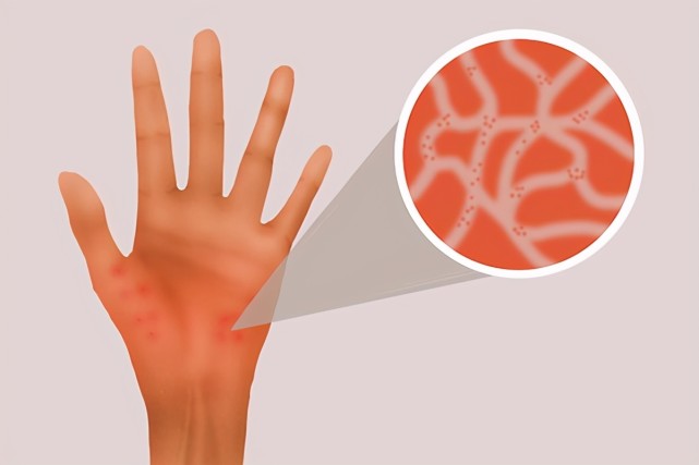 麻疹后,吃什么好,吃什么不好,清单列给你|蔬菜|荨麻疹|水果|南瓜|过敏