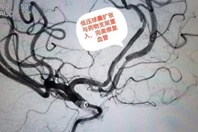 精勤不倦，着手成春：北京老年医院首例大脑前动脉支架置入术中建八局南方分公司冯军红