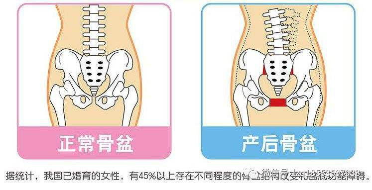 當女性產後骨盆回位出現問題的時候,便會引起諸多健康問題如:女性盆底