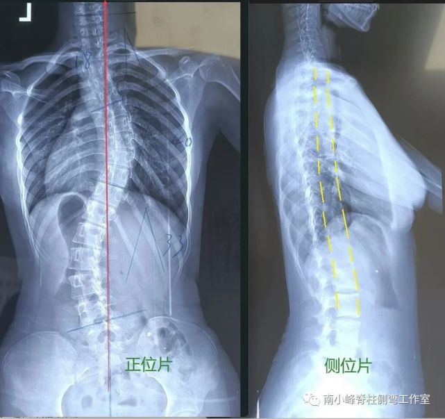 正常脊柱形態圖,可以明顯看到中間圖示上的胸椎向後的生理曲度.