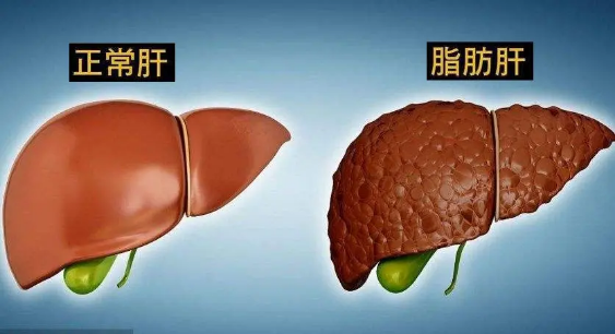 脂肪肝到肝癌,每一步怎么拯救,往下看