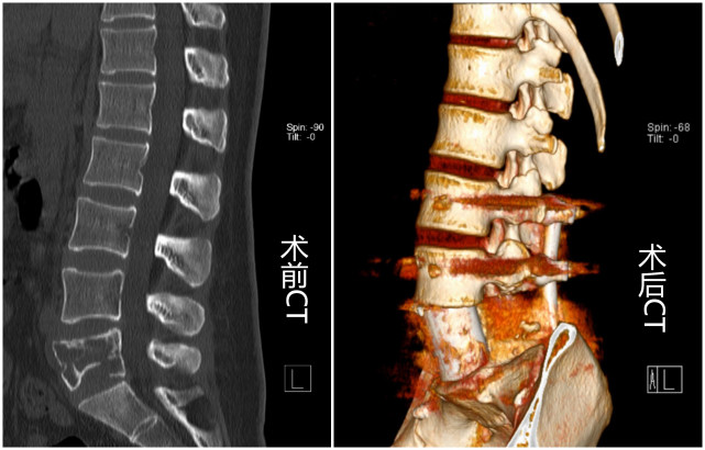 切除整塊脊柱腫瘤還用3d打印人工椎體重建好