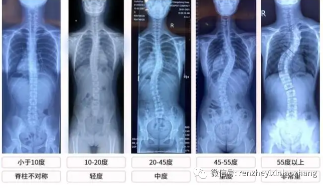 中小學生脊柱側彎不可忽視脊柱側彎會嚴重影響到他們學習成績