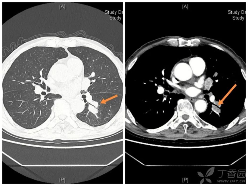 肺内多发病变 奇怪的支气管充气征_腾讯新闻