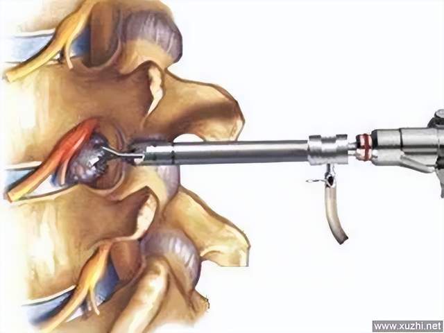 椎間孔鏡手術微創治療頸腰椎間盤突出症