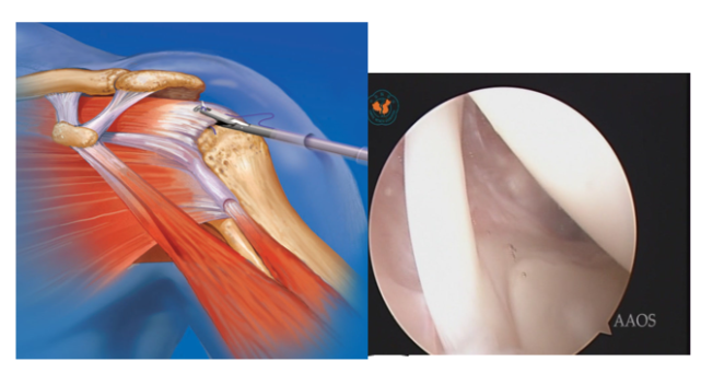 肩袖損傷修復術bankart損傷修復術slap損傷修復術肩峰成形術肩關節鏡