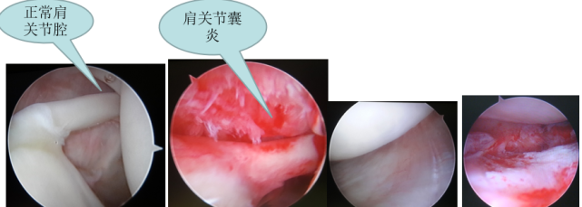 典型的表現:肩部疼痛,僵硬,各個方向主動與被動活動都受限專業分析