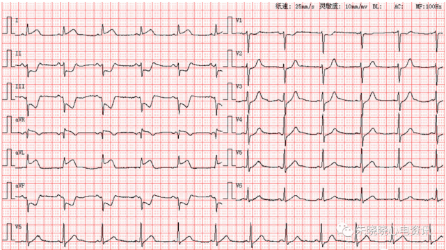 每日读图 || 第1725期 急性高侧壁心肌梗死 左前分支传导阻滞