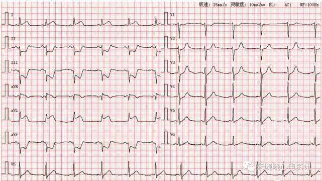 典型心梗心电图图片