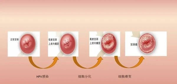 7%的宫颈癌中发现了高危型hpv感染,导致全球每年约49.