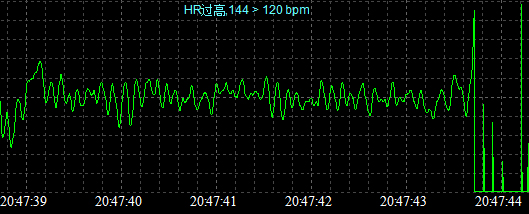 发现病人出现室颤连接除颤监护仪心肺复苏术急救人员抵达,迅速接管