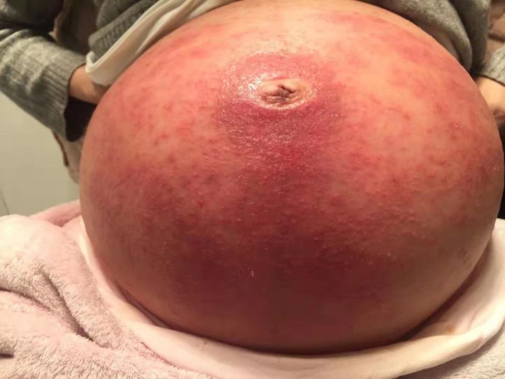 好不容易熬过一夜,早起淋药浴时我发现,肚子像是从中间开始腐烂的苹果