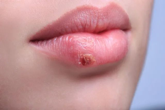 撕死皮舔嘴唇这些小动作别忽视可能会增加患癌风险