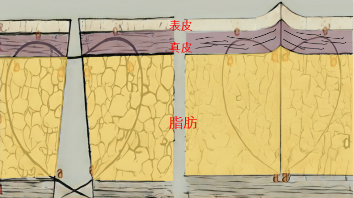 腹腔镜戳卡切口皮下缝合分享7个有诚意的小技巧