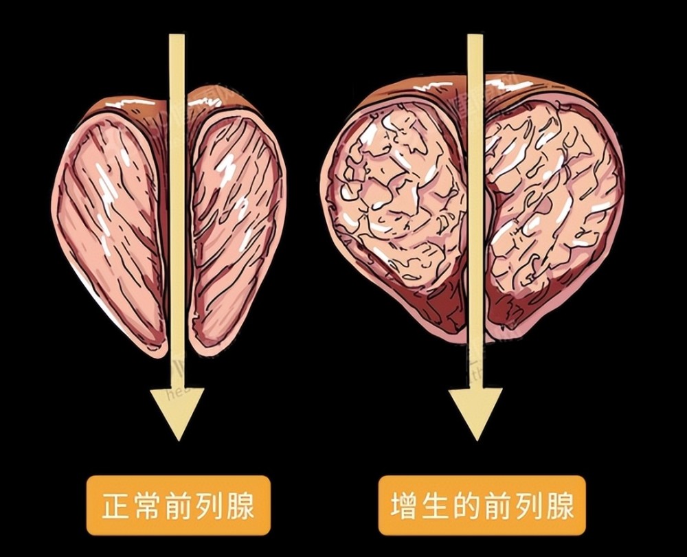 什么信号提示前列腺增生需要干预了本文告诉你