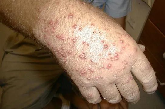 带娃去户外当心 6 类毒虫,尤其第一种,严重可致命(附急救方法)_腾讯