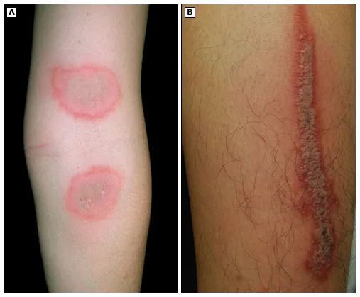 带娃去户外当心 6 类毒虫,尤其第一种,严重可致命