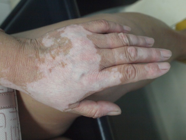 这12种疾病同样会导致皮肤变白!-白癜风