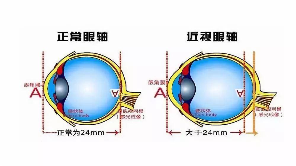 趣味学知识近视眼太严重会导致失明吗